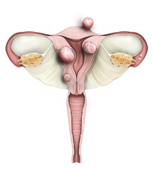 varicele vaselor uterine