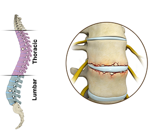 Fracture of the Thoracic and Lumbar Spine