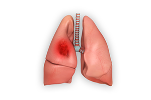 Lung Cancer