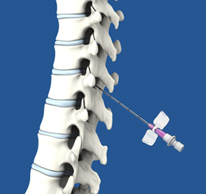 Advanced Pain Management Intervention