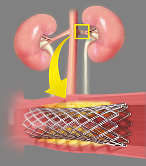 Renal Artery Angioplasty