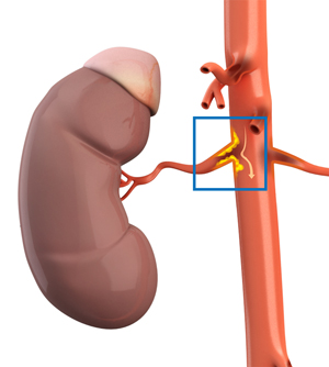 Renal Artery Stenosis