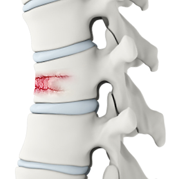 Spine Fractures