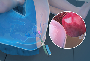 Transperineal Prostate Biopsy