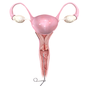 Vaginal Biopsy