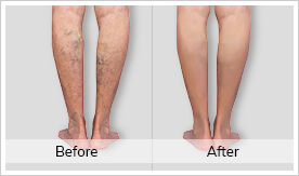 Varicose Veins