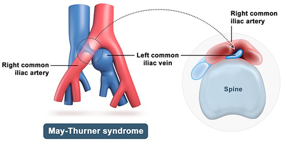 Venous Disease